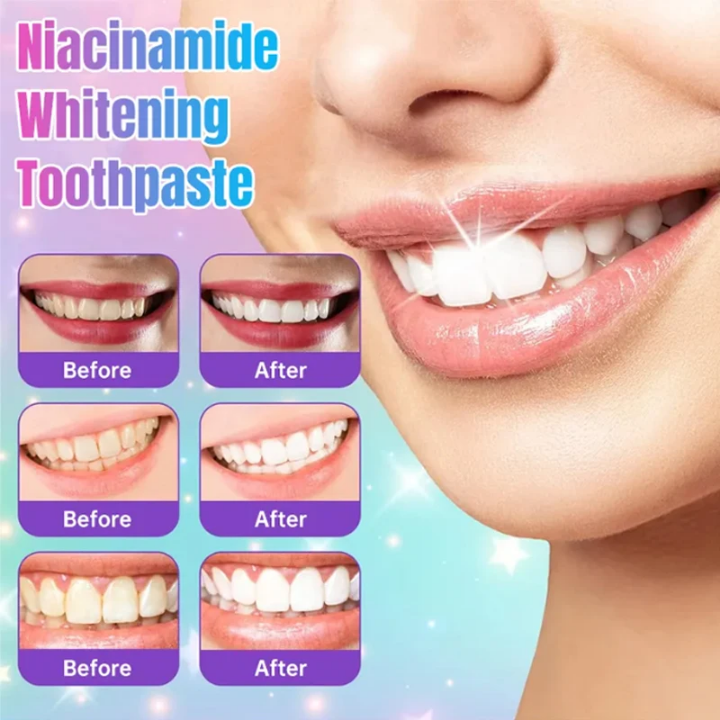 Gel de blanchiment dentaires